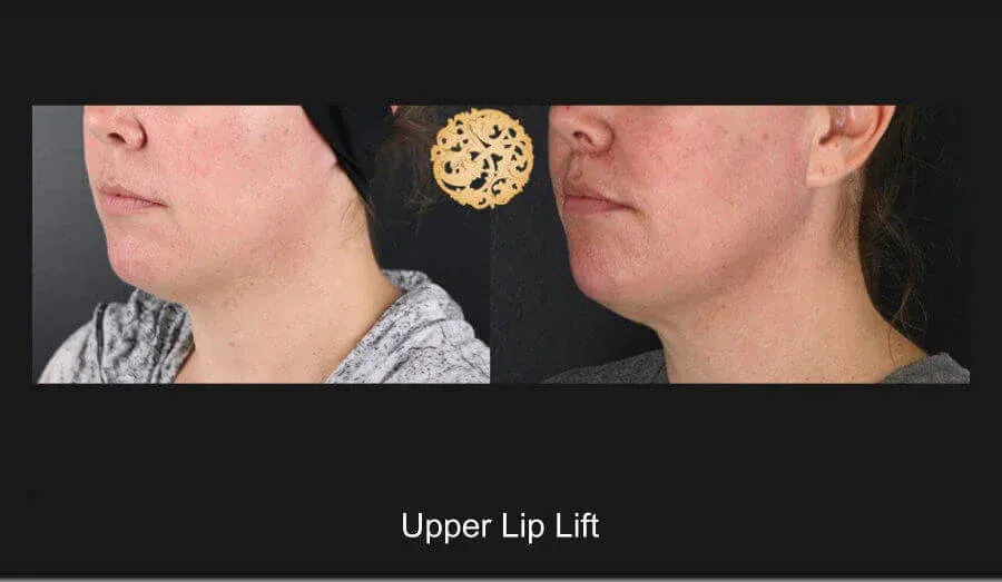 Lip Lift Before & After