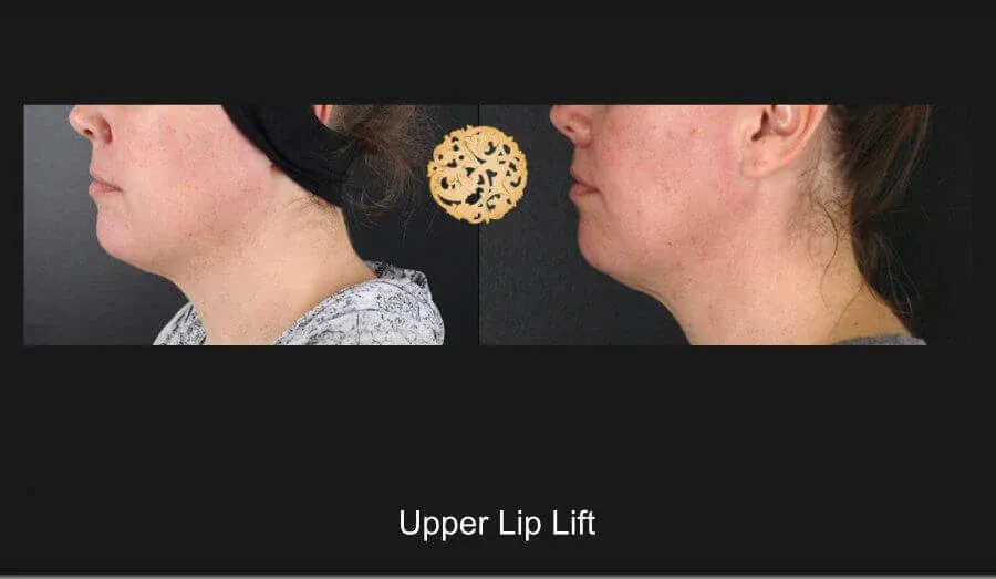Lip Lift Before & After