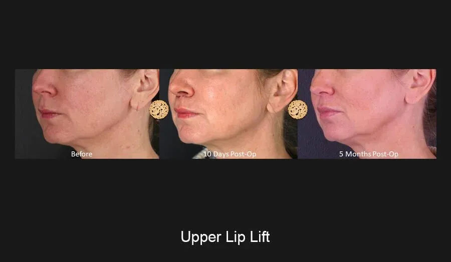 Lip Lift Before & After