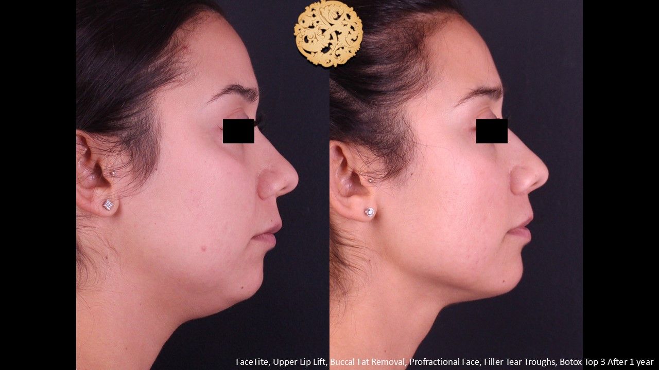 Lip Lift Before & After