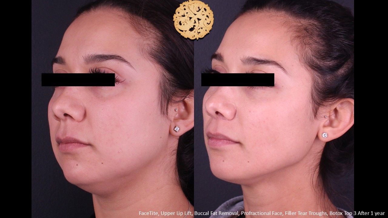 Lip Lift Before & After