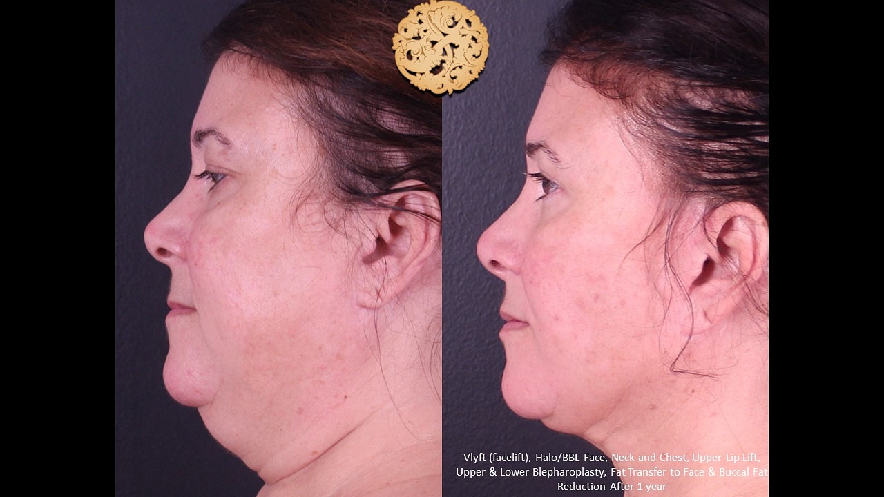 Lip Lift Before & After