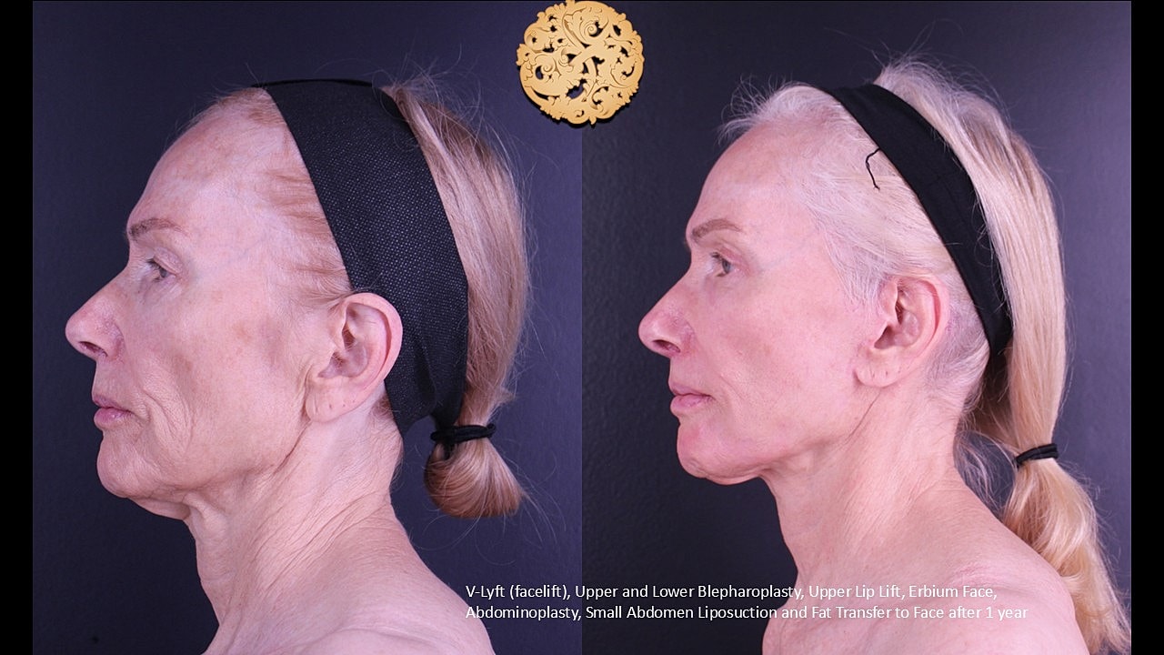 Lip Lift Before & After
