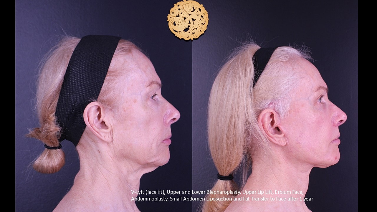 Lip Lift Before & After