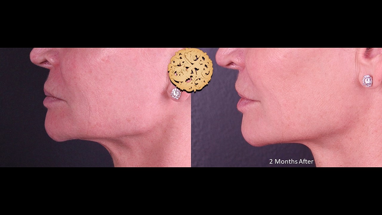 Lip Lift Before & After