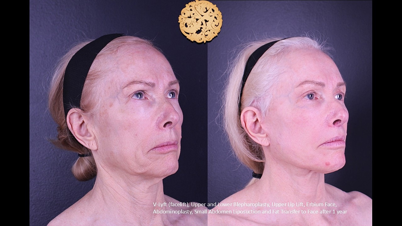Lip Lift Before & After