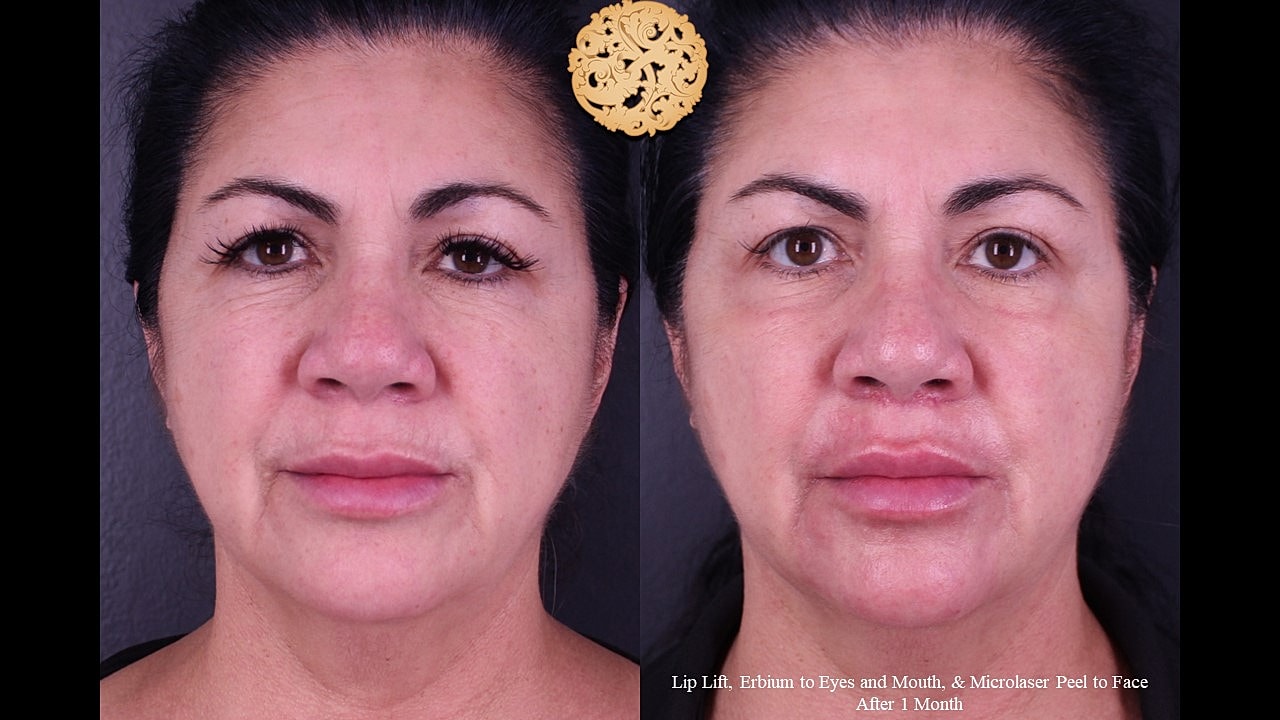 Lip Lift Before & After