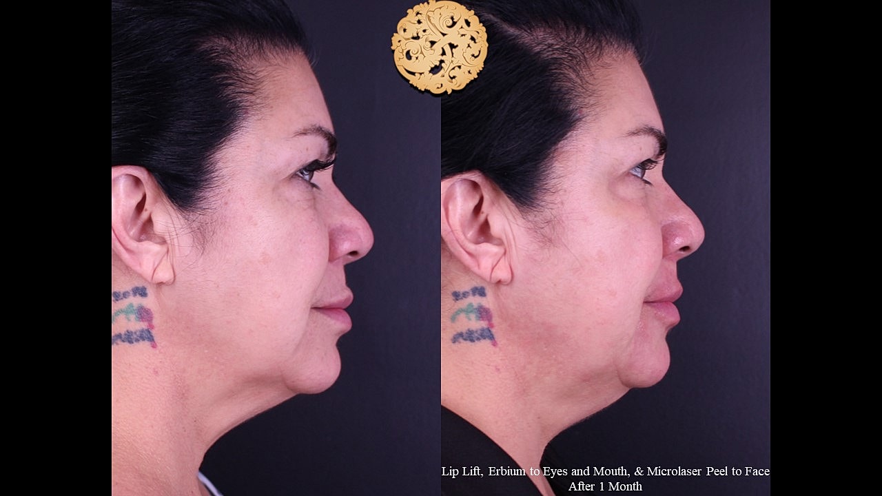 Lip Lift Before & After