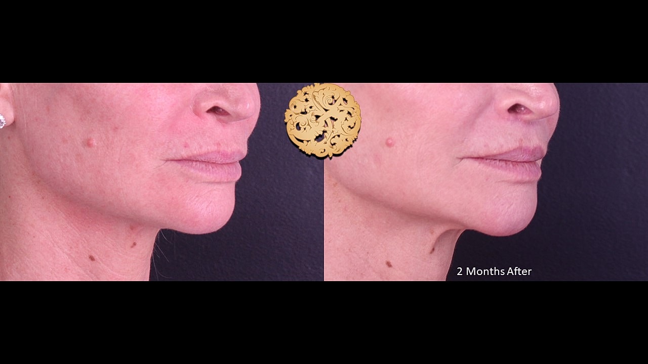 Lip Lift Before & After