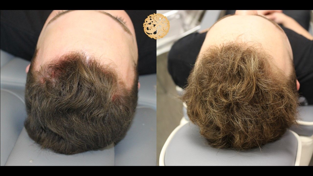 Prp Hair Restoration Before & After