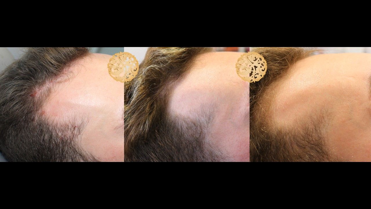 Prp Hair Restoration Before & After