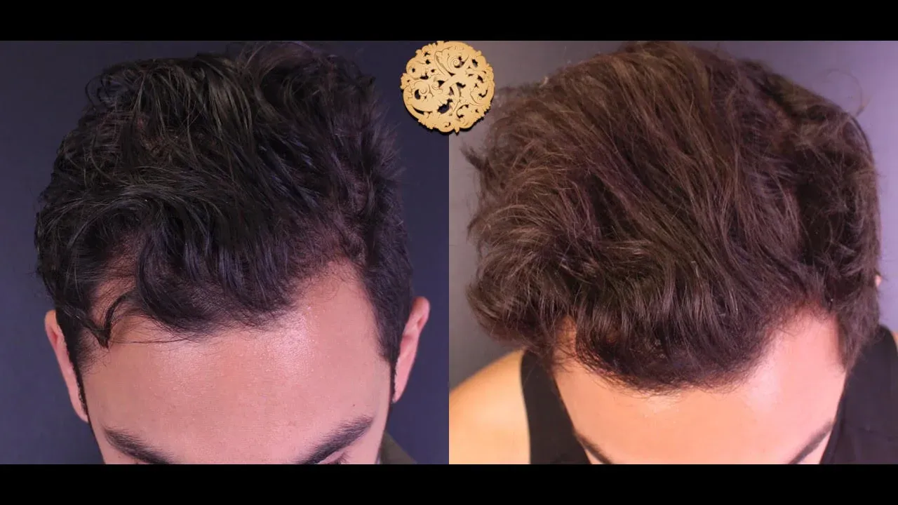 Prp Hair Restoration Before & After