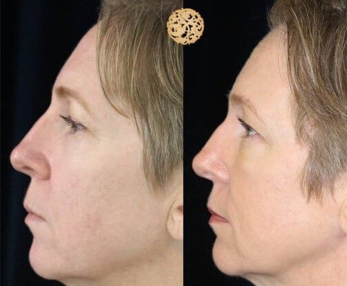 PDO Threads Before & After