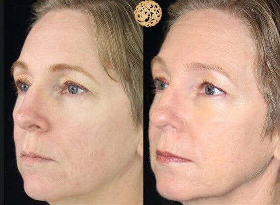 PDO Threads Before & After