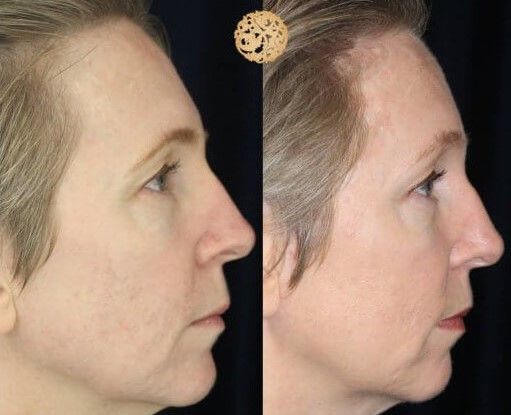 Pdo Threads Before & After