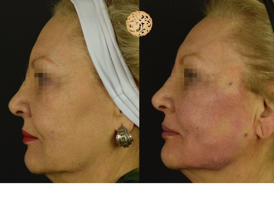 PDO Threads Before & After