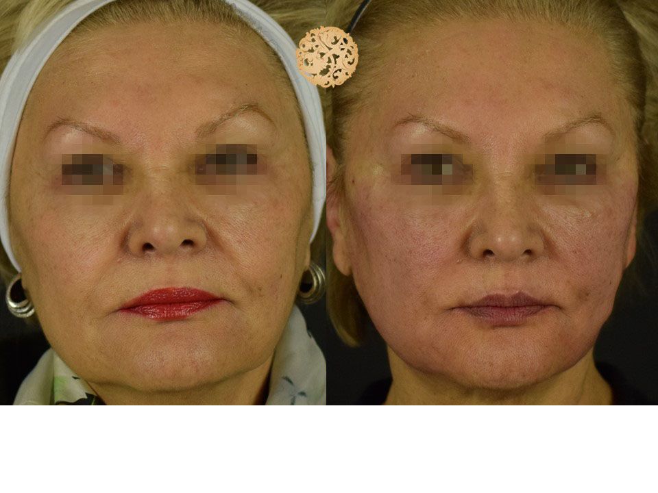 Pdo Threads Before & After