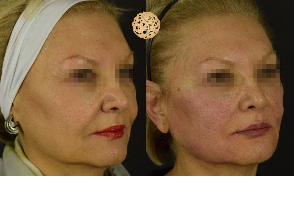 Pdo Threads Before & After