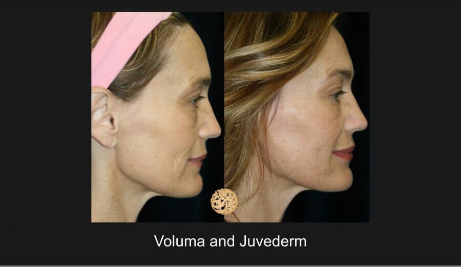 Dermal Filler Before & After