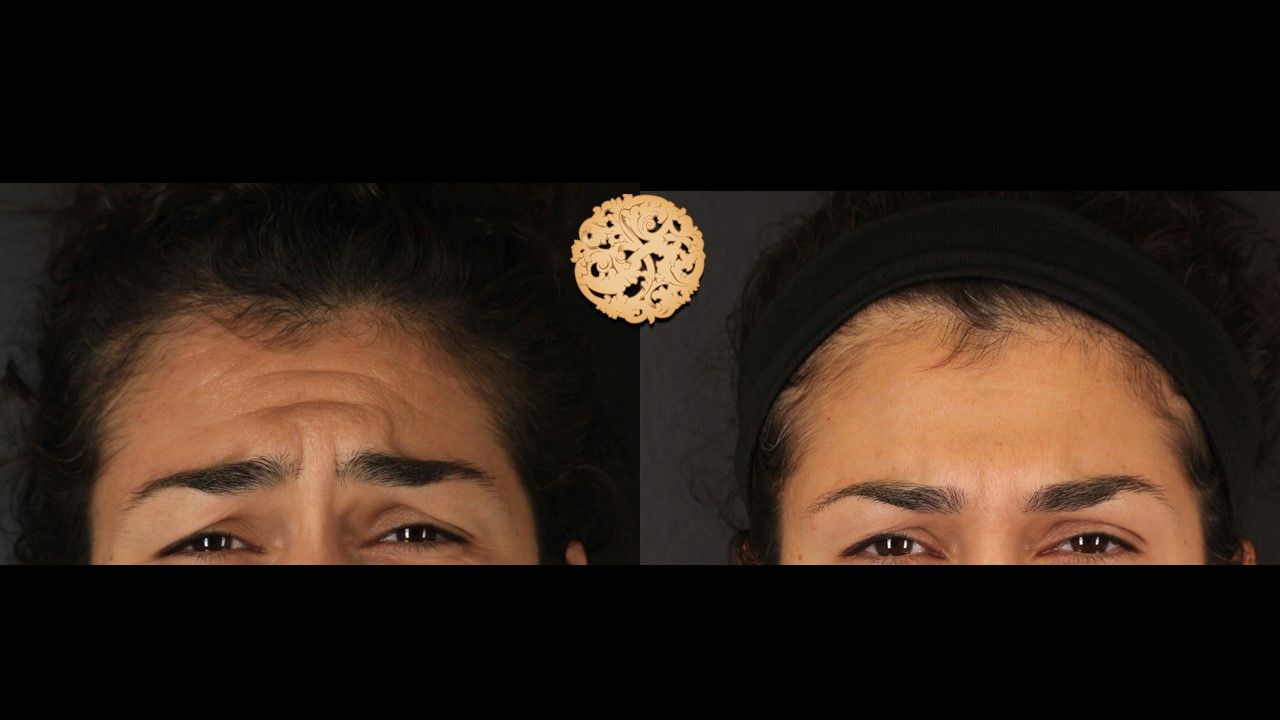 Botox Before & After