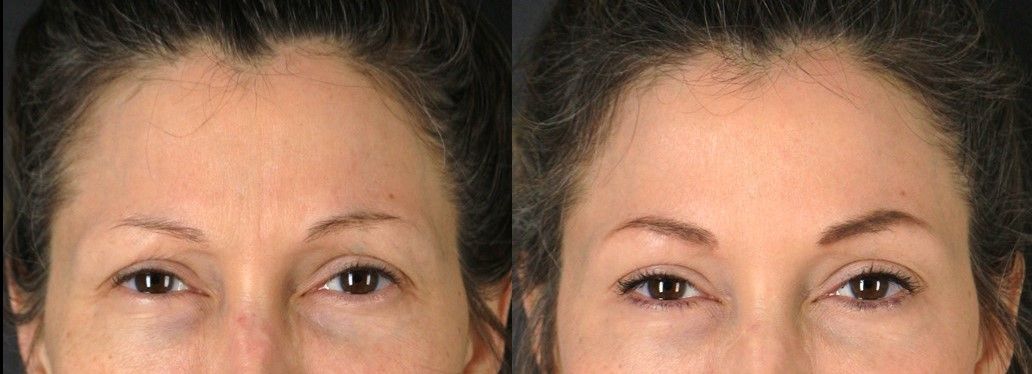 Botox Before & After