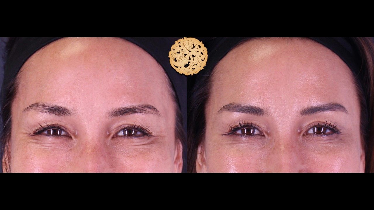 Botox Before & After