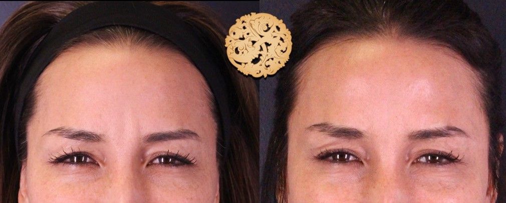 Botox Before & After