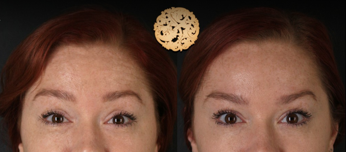 Botox Before & After