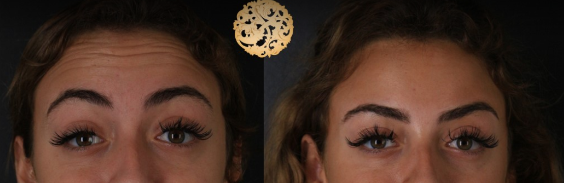 Botox Before & After