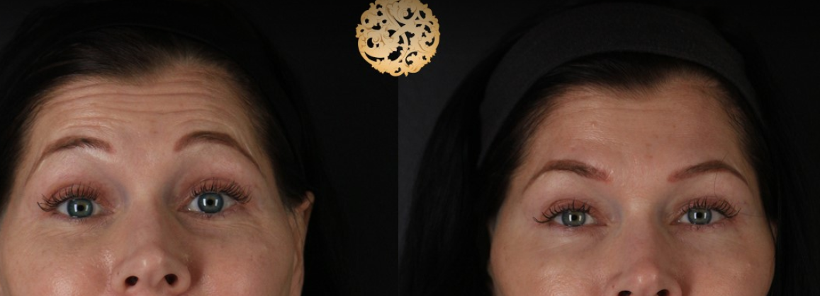 Botox Before & After