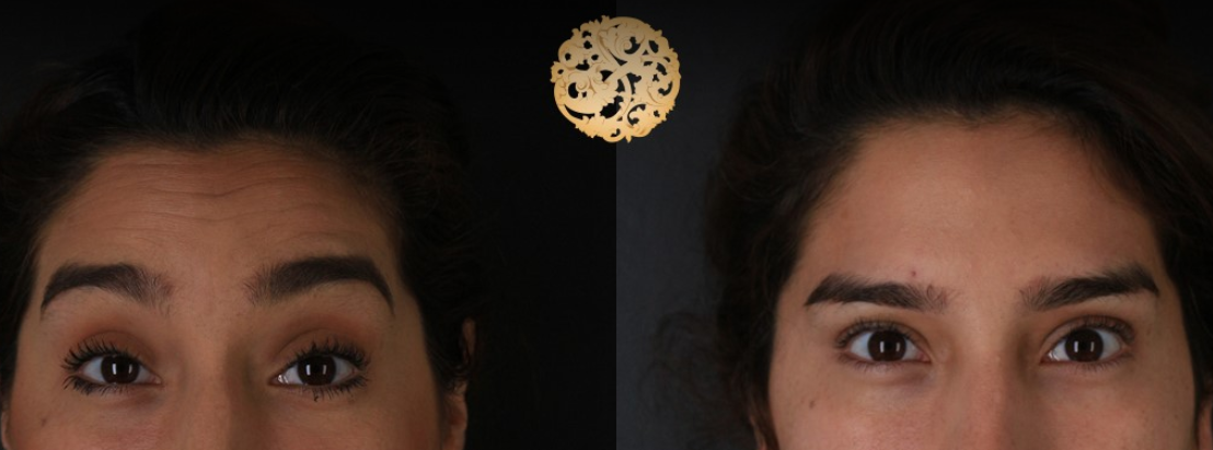 Botox Before & After