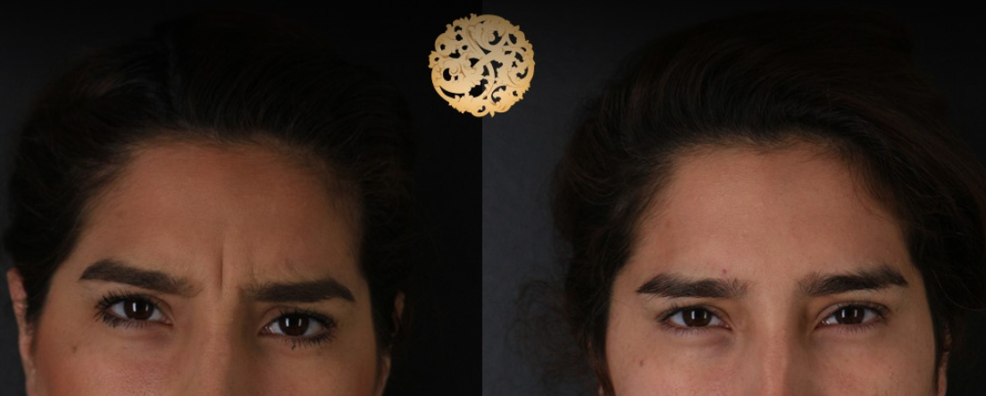 Botox Before & After