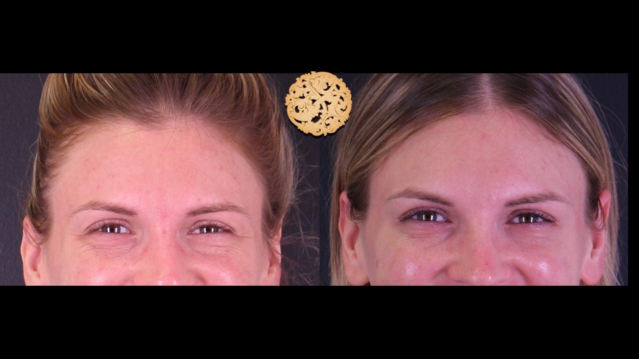 Botox Before & After
