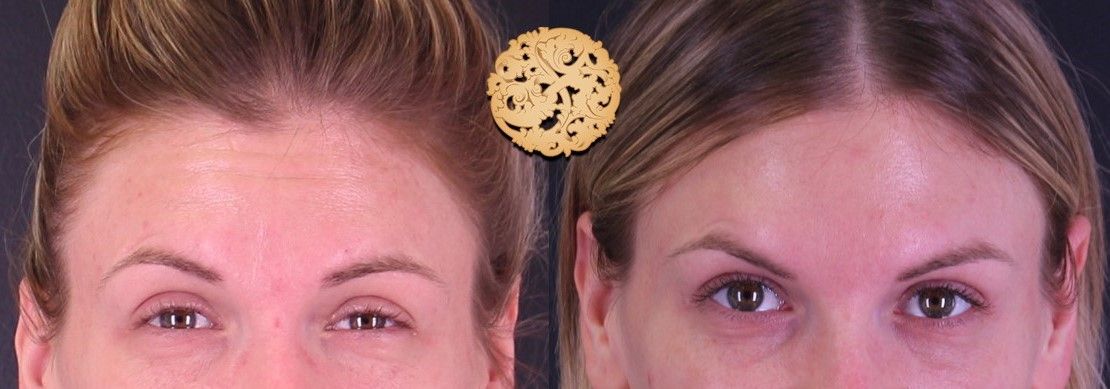 Botox Before & After