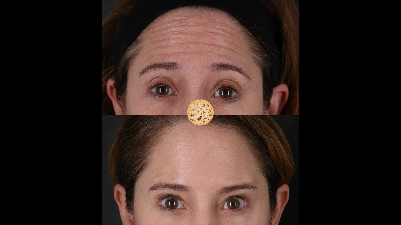 Botox Before & After