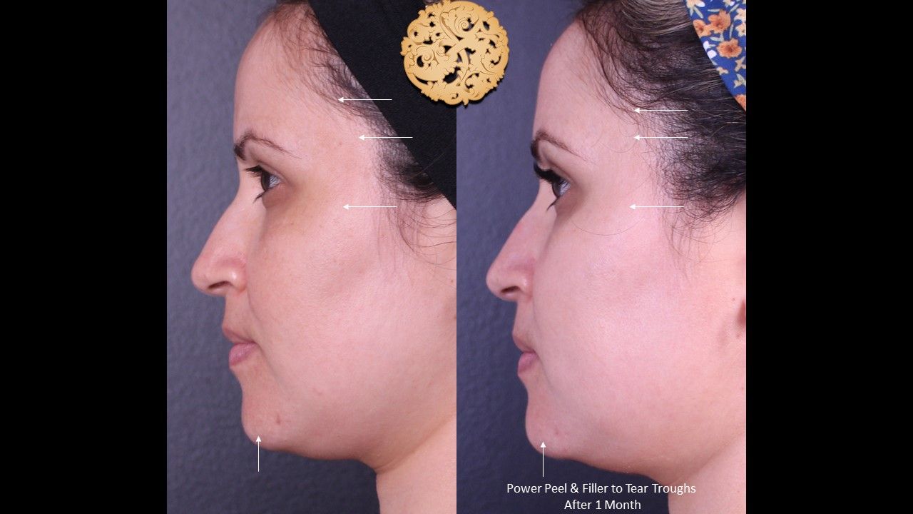 Botox Before & After