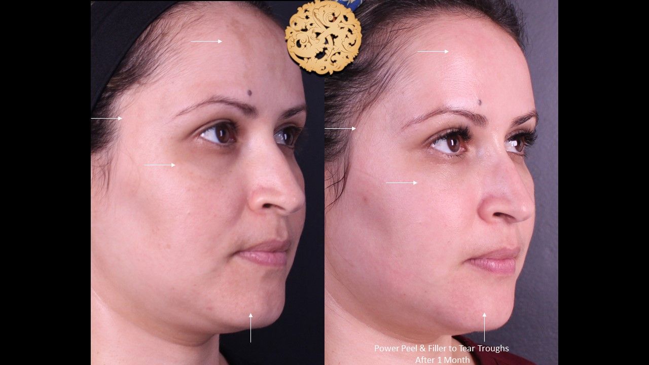 Botox Before & After