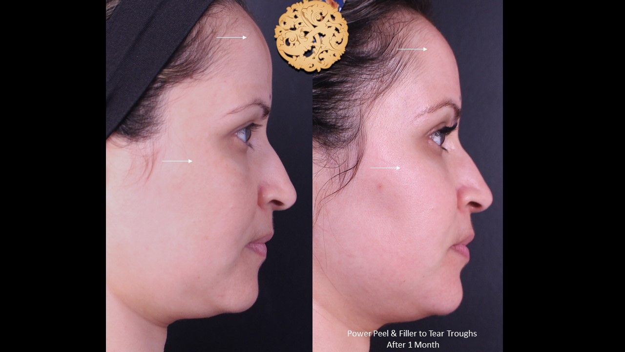 Botox Before & After