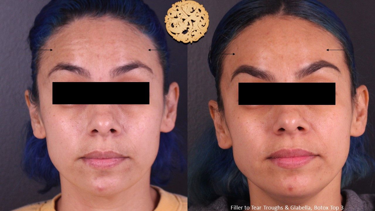 Botox Before & After