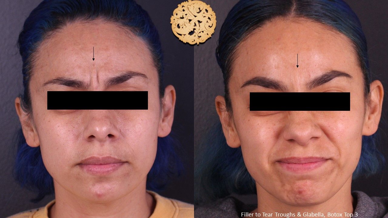 Botox Before & After