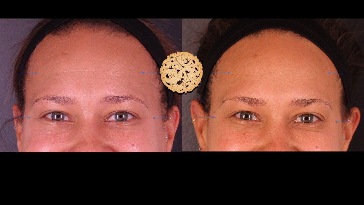 Botox Before & After