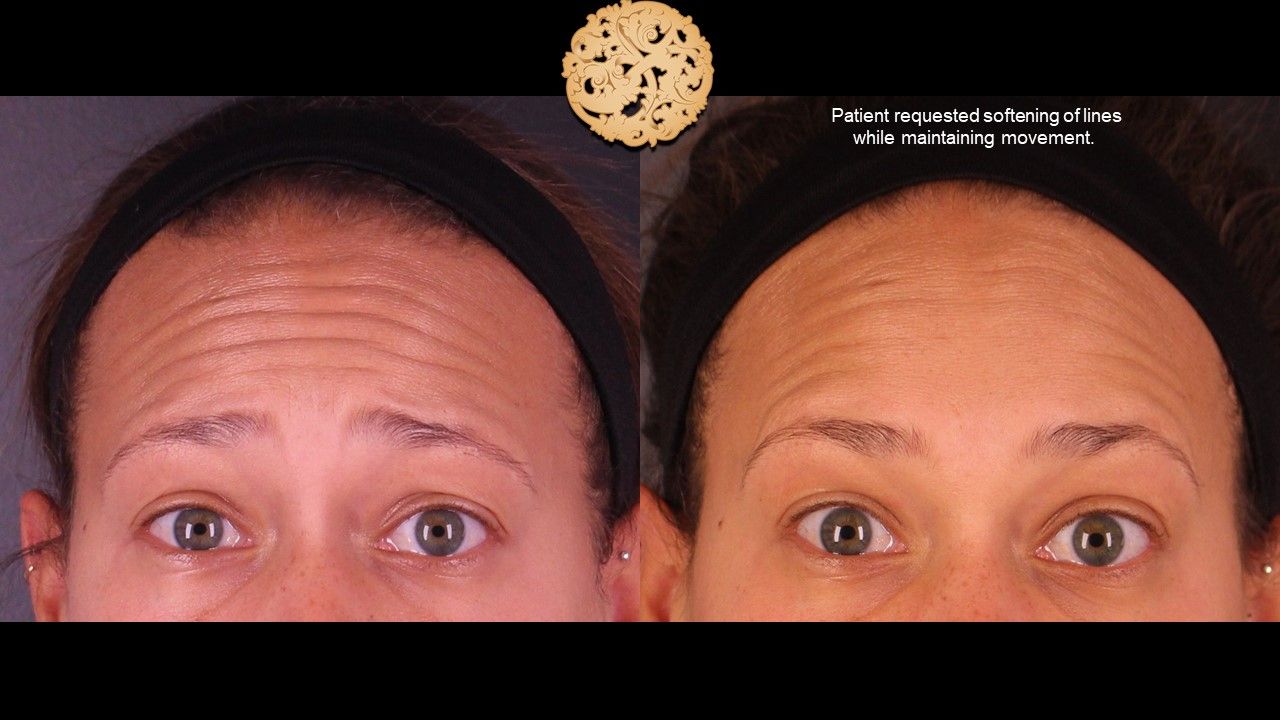 Botox Before & After