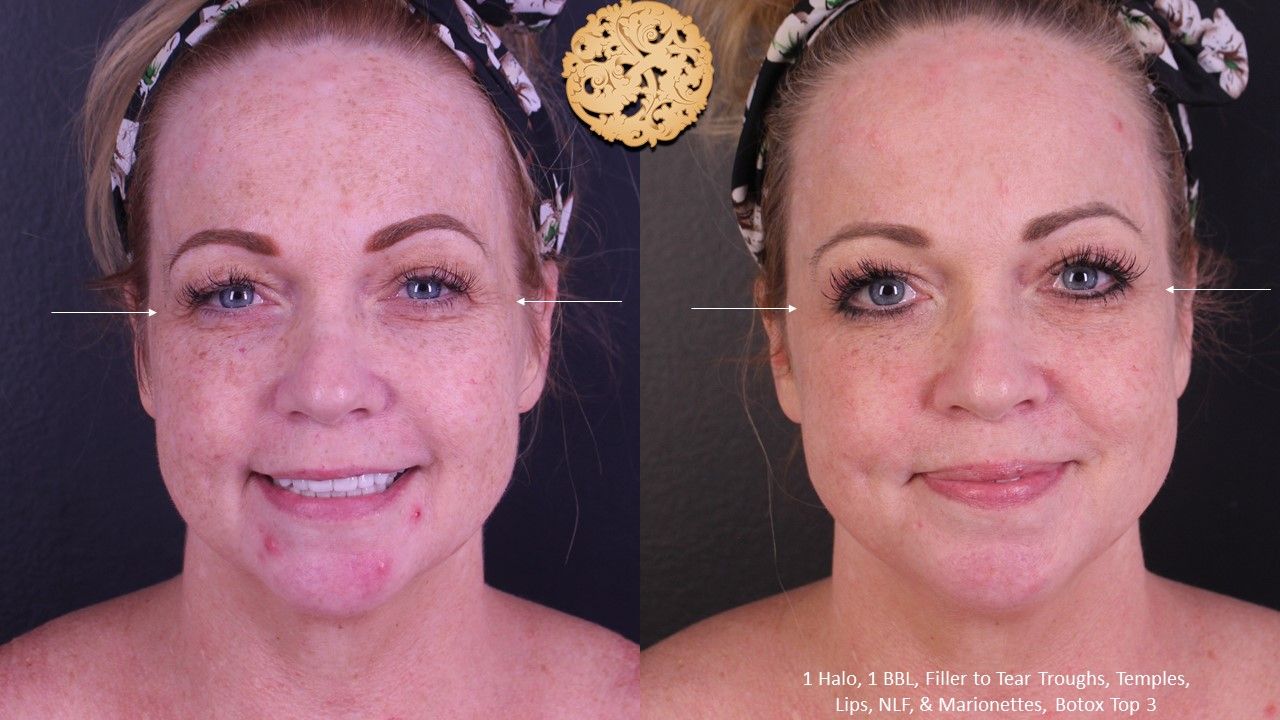 Botox Before & After