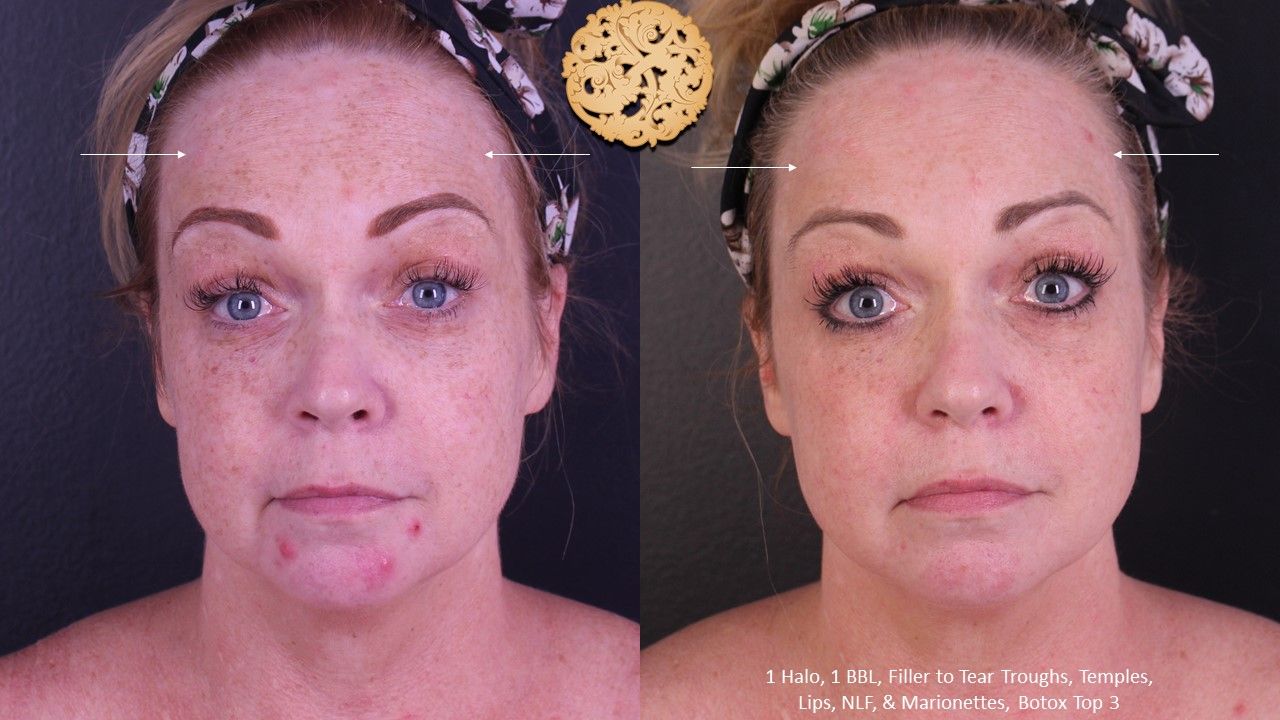 Botox Before & After