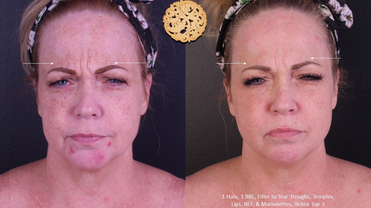 Botox Before & After
