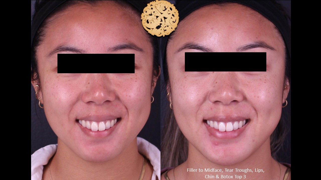 Botox Before & After