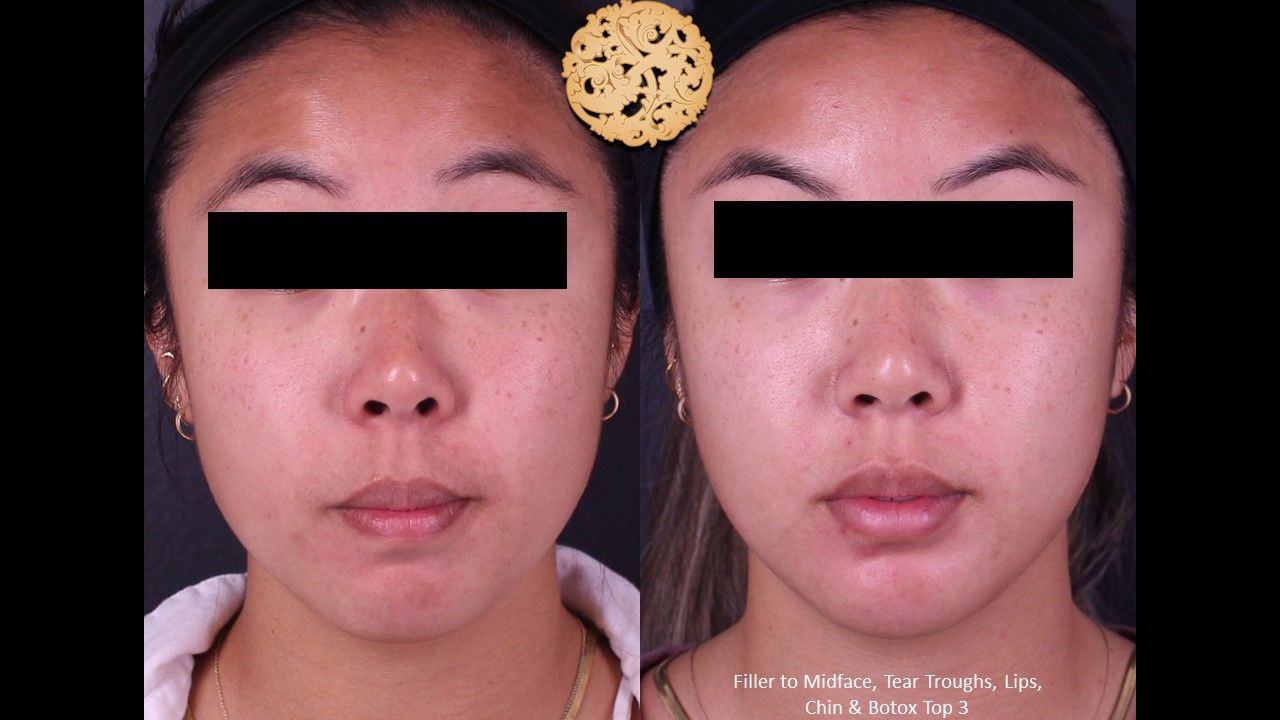 Botox Before & After