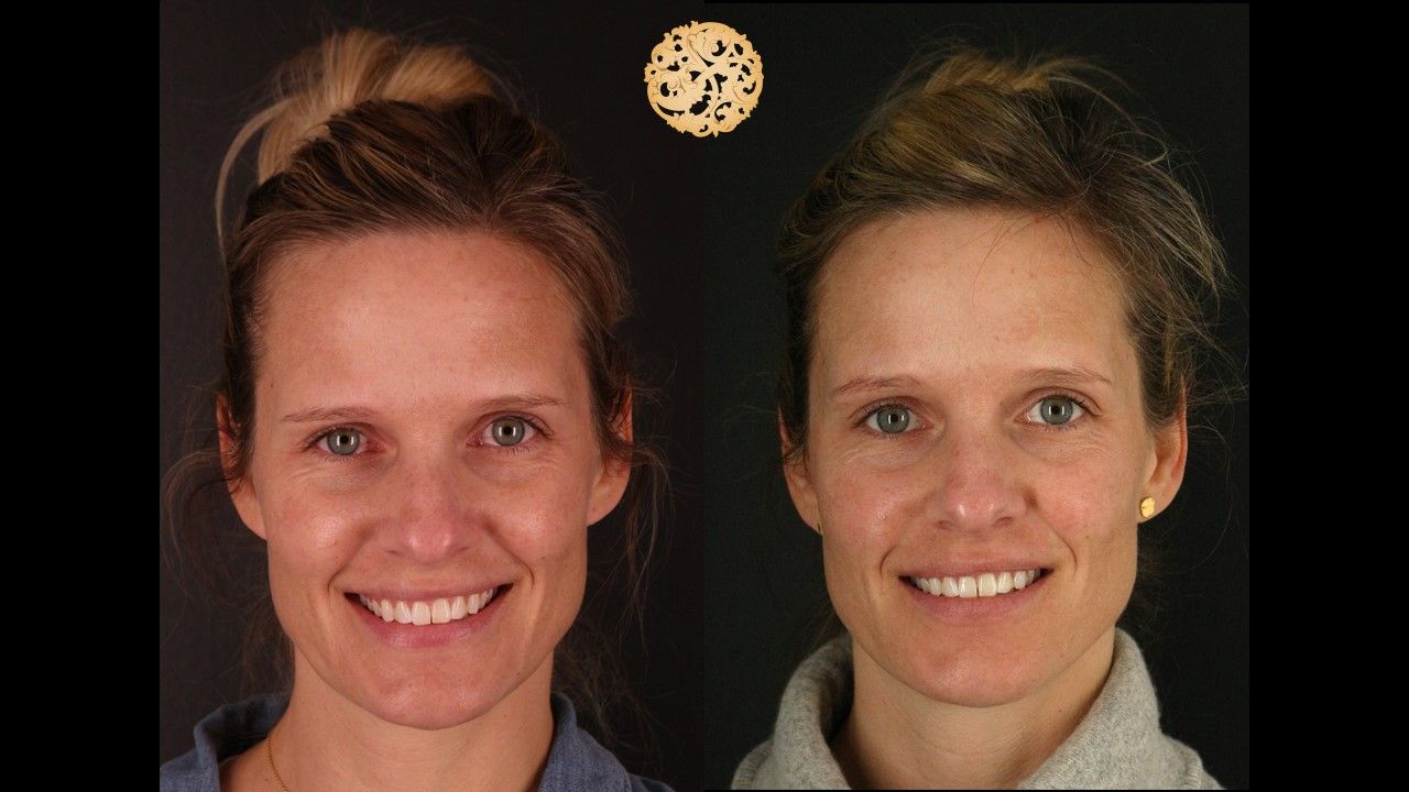 Botox Before & After