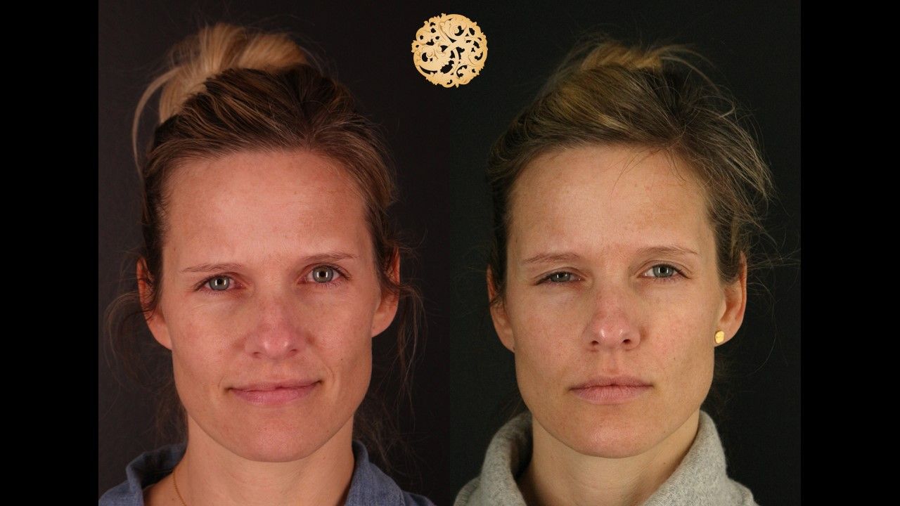 Botox Before & After