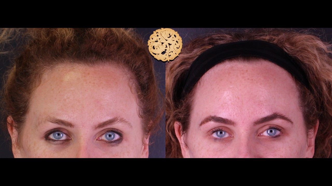 Botox Before & After